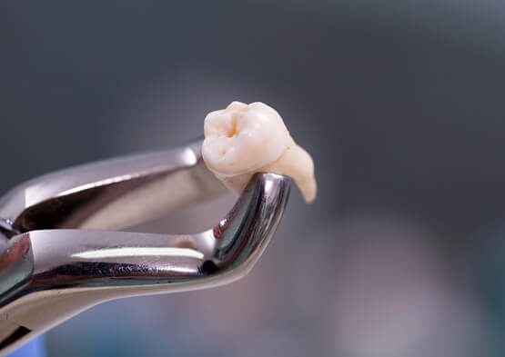 someone holding a tooth in forceps