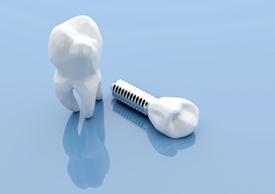 Model tooth compared with dental implant